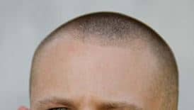 MHP behandeling en micro haar pigmentatie behandeling