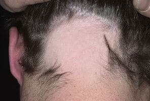 Micro haar pigmentatie bij alopecia of alopecia areata?