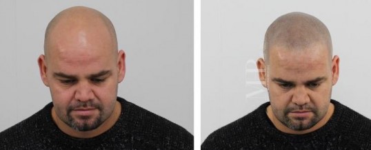 Micro haar pigmentatie betekenis of uitleg