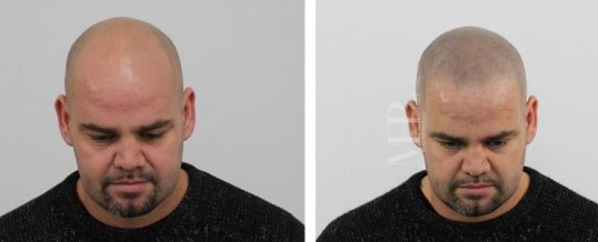 Micro haar pigmentatie informatie