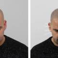 Micro haar pigmentatie na haartransplantatie
