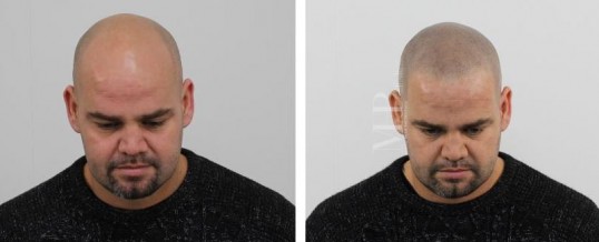 Micro haar pigmentatie na haartransplantatie