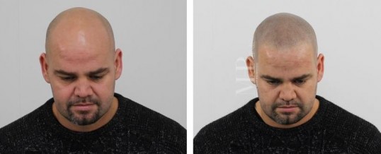 Micro haar pigmentatie voorbeelden