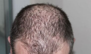 Micro haar pigmentatie als oplossing voor erfelijke haaruitval?