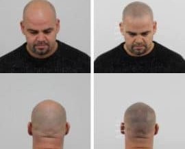 Micro haar pigmentatie of haartransplantatie?