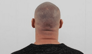 FUE littekens behandelen met micro haar pigmentatie