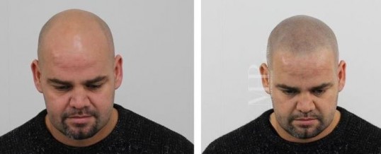 Micro haar pigmentatie syoniemen